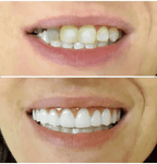 Dentadura Universal NewSmile Ajustável, Discreta e Confortável – Kit Prótese Dental Completa Compre 1 e Leve 2