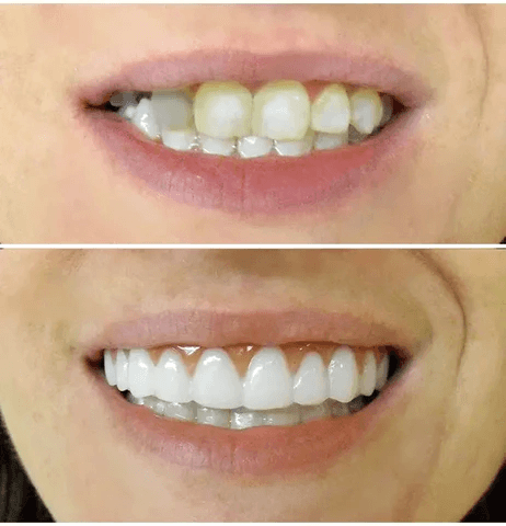 Dentadura Universal NewSmile Ajustável, Discreta e Confortável – Kit Prótese Dental Completa Compre 1 e Leve 2